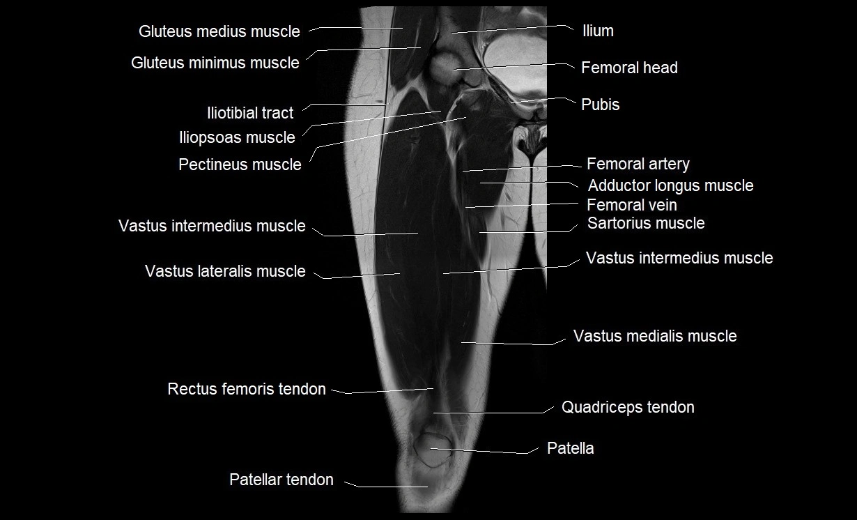 MRI thigh coronal cross sectional anatomy image 8.webp